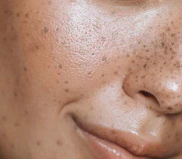 treat melasma